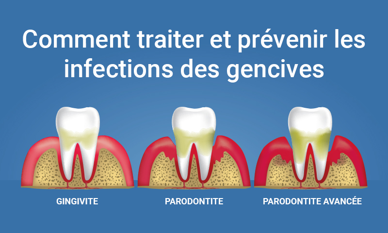 Comment traiter et prévenir les infections des gencives